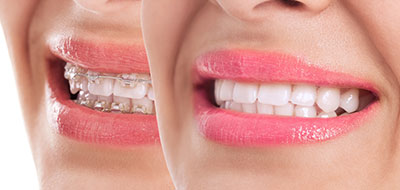 The image is a composite of two photographs, one on the left and one on the right. The left side shows a close-up of a person s face with a neutral expression. The right side features a smiling mouth with teeth visible against a blurred background.