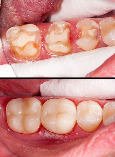 Close-up of a person s mouth showing dental work with a focus on the teeth and gums.